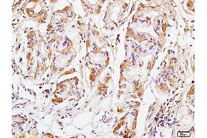 Formalin-fixed and paraffin embedded human colon carcinoma labeled with Anti GM130 Polyclonal Antibody, Unconjugated (ABIN872349) at 1:200 followed by conjugation to the secondary antibody and DAB staining (Golgin A2 (GOLGA2) (AA 851-1002) antibody)