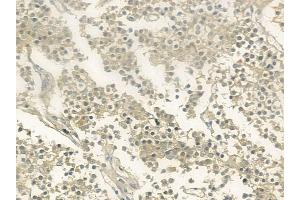 ABIN6260530 and ABIN6273206 at 1/100 staining human pituitary adenoma by IHC-P. (CCDC93 antibody  (C-Term))