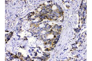 MUT was detected in paraffin-embedded sections of human intetsinal cancer tissues using rabbit anti- MUT Antigen Affinity purified polyclonal antibody (Catalog # ) at 1 µg/mL. (MUT antibody  (N-Term))