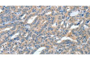 Immunohistochemistry of paraffin-embedded Human thyroid cancer tissue using ANGPT1 Polyclonal Antibody at dilution 1:50 (Angiopoietin 1 antibody)