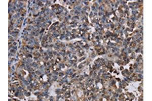 The image on the left is immunohistochemistry of paraffin-embedded Human ovarian cancer tissue using ABIN7130066(LBR Antibody) at dilution 1/50, on the right is treated with fusion protein.