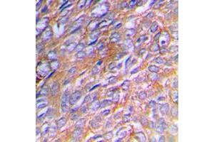 Immunohistochemical analysis of Collagen 3 alpha 1 staining in human breast cancer formalin fixed paraffin embedded tissue section. (COL3A1 antibody  (N-Term))