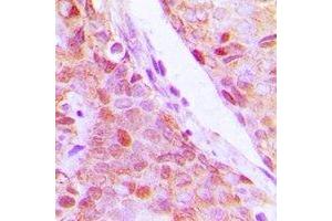 Immunohistochemical analysis of RPL5 staining in human breast cancer formalin fixed paraffin embedded tissue section.