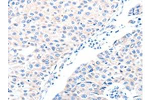 The image on the left is immunohistochemistry of paraffin-embedded Human breast cancer tissue using ABIN7128234(ADAM32 Antibody) at dilution 1/15, on the right is treated with fusion protein. (ADAM32 antibody)