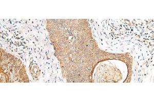 Immunohistochemistry of paraffin-embedded Human esophagus cancer tissue using TOR1A Polyclonal Antibody at dilution of 1:35(x200) (TOR1A antibody)