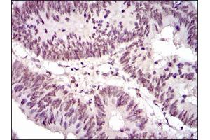 Immunohistochemical analysis of paraffin-embedded rectum cancer tissues using NCK1 mouse mAb with DAB staining.