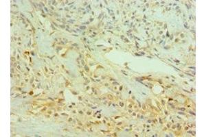 Immunohistochemistry of paraffin-embedded human breast cancer using ABIN7145333 at dilution of 1:100 (TRKB antibody  (AA 32-282))