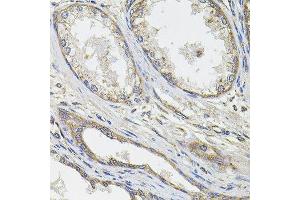 Immunohistochemistry of paraffin-embedded human prostate cancer using UBE2S antibody. (UBE2S antibody  (AA 122-221))