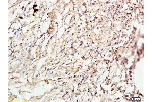 Formalin-fixed and paraffin embedded human lung carcinoma labeled with Anti-ROCK1 Polyclonal Antibody, Unconjugated  at 1:200 followed by conjugation to the secondary antibody and DAB staining.