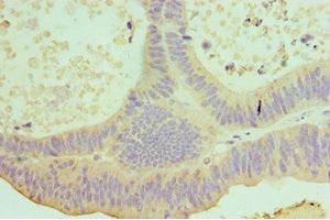 Immunohistochemistry of paraffin-embedded human colon cancer using ABIN7156853 at dilution of 1:100 (IL-22 antibody  (AA 34-179))