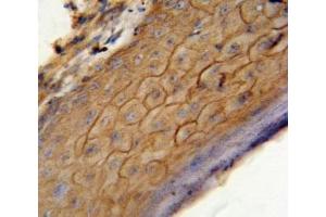 CB2 antibody immunohistochemistry analysis in formalin fixed and paraffin embedded human skin carcinoma.