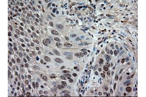 Immunohistochemical staining of paraffin-embedded Adenocarcinoma of colon using anti-NTF3 (ABIN2452683) mouse monoclonal antibody. (Neurotrophin 3 antibody  (AA 139-257))