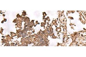 Immunohistochemistry of paraffin-embedded Human lung cancer tissue using FAAP24 Polyclonal Antibody at dilution of 1:30(x200) (FAAP24 antibody)