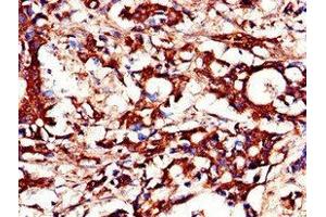 Immunohistochemistry of paraffin-embedded human gastric cancer using ABIN7150756 at dilution of 1:100 (DUSP19 antibody  (AA 1-217))