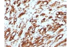 IHC testing of FFPE human rhabdomyosarcoma with Muscle Actin antibody (Actin antibody)