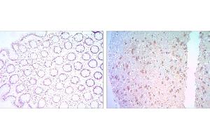 Immunohistochemical analysis of paraffin-embedded colon cancer tissues (left) and human brain tissues (right) using BCL-2 mouse mAb with DAB staining. (Bcl-2 antibody)