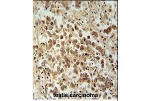 VCX1 Antibody (N-term) (ABIN654781 and ABIN2844462) immunohistochemistry analysis in formalin fixed and paraffin embedded human testis carcinoma followed by peroxidase conjugation of the secondary antibody and DAB staining. (VCX antibody  (N-Term))