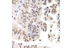 Immunohistochemistry of paraffin-embedded human colon carcinoma using SOX5 antibody. (SOX5 antibody  (AA 1-120))