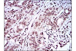 Immunohistochemical analysis of paraffin-embedded cervical cancer tissues using ZEB1 mouse mAb with DAB staining. (ZEB1 antibody  (AA 967-1108))