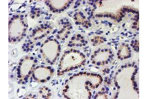 Immunohistochemical staining of paraffin-embedded Carcinoma of Human thyroid tissue using anti-KCNAB1 mouse monoclonal antibody.