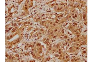 IHC image of ABIN7139904 diluted at 1:100 and staining in paraffin-embedded human liver cancer performed on a Leica BondTM system. (AJUBA antibody  (AA 61-77))