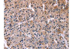 The image on the left is immunohistochemistry of paraffin-embedded Human liver cancer tissue using ABIN7128938(CHRM1 Antibody) at dilution 1/20, on the right is treated with fusion protein. (CHRM1 antibody)