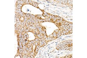 Immunohistochemistry of paraffin-embedded human colon carcinoma using L2 Rabbit pAb (ABIN7265513) at dilution of 1:50 (40x lens). (AFG3L2 antibody  (AA 538-797))