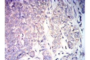 Immunohistochemical analysis of paraffin-embedded bladder cancer tissues using BAX mouse mAb with DAB staining. (BAX antibody)