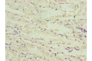 Immunohistochemistry of paraffin-embedded human gastric cancer using ABIN7160967 at dilution of 1:100 (NDUFS6 antibody  (AA 29-124))