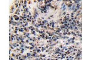 IHC-P analysis of esophagus cancer tissue, with DAB staining. (Ki-67 antibody  (AA 3088-3235))