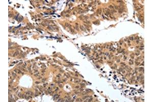 The image on the left is immunohistochemistry of paraffin-embedded Human colon cancer tissue using ABIN7130598(PGC Antibody) at dilution 1/25, on the right is treated with fusion protein. (PGC antibody)
