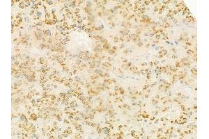 ABIN6264276 and ABIN6279342 at 1/100 staining human hepatocellular carcinoma by IHC-P. (PLA2G4F antibody  (C-Term))
