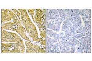 Immunohistochemistry analysis of paraffin-embedded human liver carcinoma tissue, using CYP2D6 antibody.