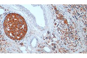 Detection of CTSD in Human Breast cancer Tissue using Monoclonal Antibody to Cathepsin D (CTSD) (Cathepsin D antibody  (AA 21-412))