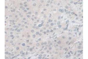 IHC-P analysis of Human Prostate Gland Cancer Tissue, with DAB staining. (PCSK1 antibody  (AA 500-738))