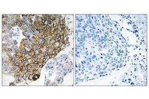 Immunohistochemistry analysis of paraffin-embedded human lung carcinoma tissue using GJA3 antibody. (GJA3 antibody  (Internal Region))