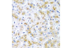 Immunohistochemistry of paraffin-embedded human liver damage using WNT2 antibody (ABIN6130801, ABIN6150239, ABIN6150241 and ABIN6221571) at dilution of 1:200 (40x lens). (WNT2 antibody  (AA 26-360))