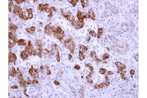 IHC-P Image ALDH6A1 antibody detects ALDH6A1 protein at mitochondria on human liver carcinoma by immunohistochemical analysis.