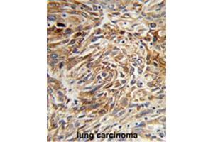 Formalin-fixed and paraffin-embedded human lung carcinoma reacted with AGR3 Antibody (C-term), which was peroxidase-conjugated to the secondary antibody, followed by DAB staining. (AGR3 antibody  (C-Term))