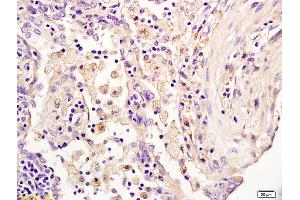 Formalin-fixed and paraffin embedded human lung (pneumonia) labeled with Anti-HAUSP/USP7 Polyclonal Antibody, Unconjugated (ABIN706346) at 1:200 followed by conjugation to the secondary antibody and DAB staining. (USP7 antibody  (AA 801-897))