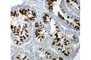 Anti-p107 antibody, IHC(P) IHC(P): Human Intestinal Cancer Tissue (p107 antibody  (C-Term))