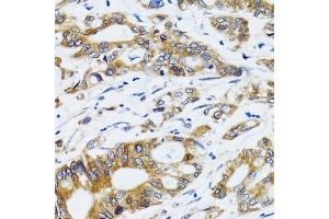 Immunohistochemistry of paraffin-embedded human colon carcinoma using PGRMC1 antibody. (PGRMC1 antibody  (AA 44-195))