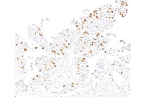 Immunohistochemistry (IHC) image for anti-Forkhead Box M1 (FOXM1) (AA 650-700) antibody (ABIN7795806) (Recombinant FOXM1 antibody  (AA 650-700))