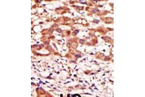 Formalin-fixed and paraffin-embedded human cancer tissue reacted with the primary antibody, which was peroxidase-conjugated to the secondary antibody, followed by AEC staining. (MGAT1 antibody  (N-Term))