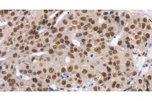 Immunohistochemistry of paraffin-embedded Human breast cancer using TAF15 Polyclonal Antibody at dilution of 1:35 (TAF15 antibody)