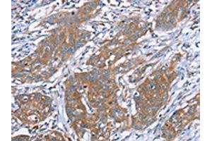 The image on the left is immunohistochemistry of paraffin-embedded Human cervical cancer tissue using ABIN7130635(PITPNM1 Antibody) at dilution 1/40, on the right is treated with fusion protein. (PITPNM1 antibody)