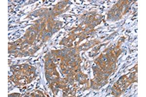 The image on the left is immunohistochemistry of paraffin-embedded Human cervical cancer tissue using ABIN7130635(PITPNM1 Antibody) at dilution 1/40, on the right is treated with fusion protein. (PITPNM1 antibody)