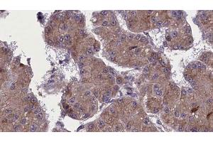 ABIN6272758 at 1/100 staining Human liver cancer tissue by IHC-P. (OR52H1 antibody)