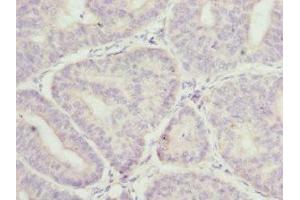 Immunohistochemistry of paraffin-embedded human endometrial cancer using ABIN7158931 at dilution of 1:100 (MR1 antibody  (AA 20-260))