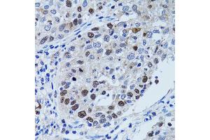 Immunohistochemistry of paraffin-embedded human lung cancer using UHRF1 antibody.